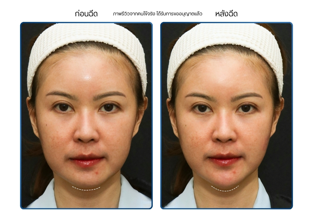 รีวิวฉีดฟิลเลอร์คาง