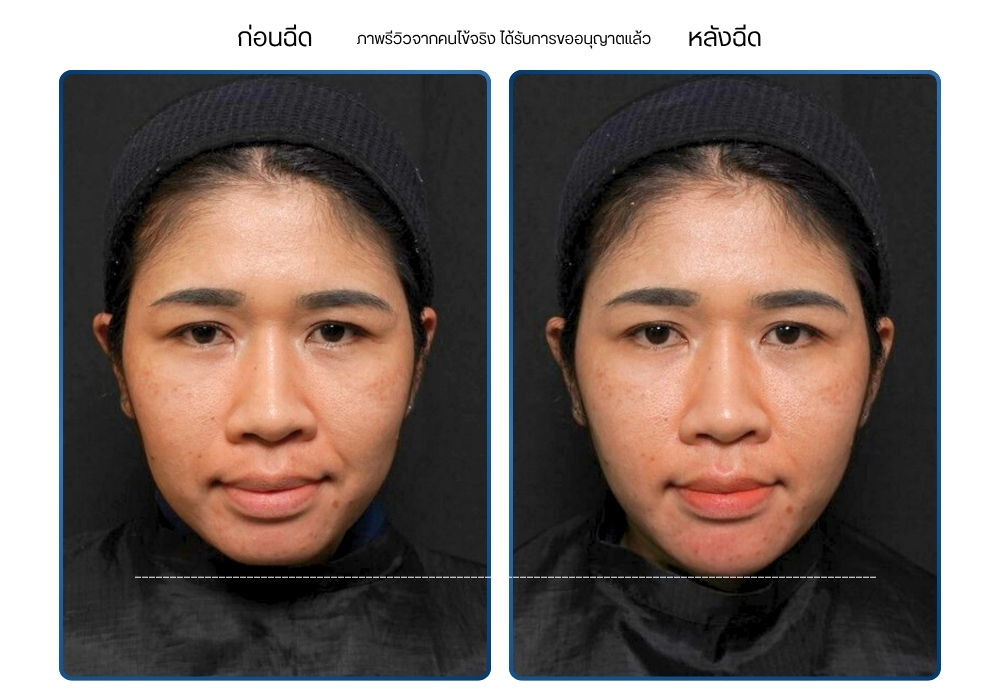 รีวิวฉีดคาง rwc clinic