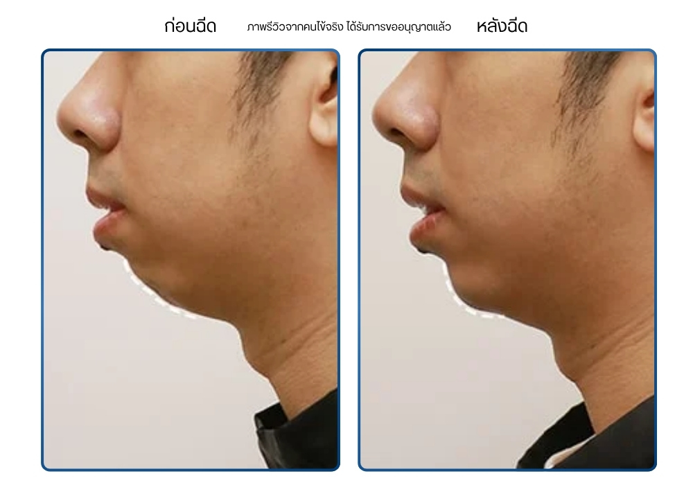 รีวิวคาง ก่อน-หลัง