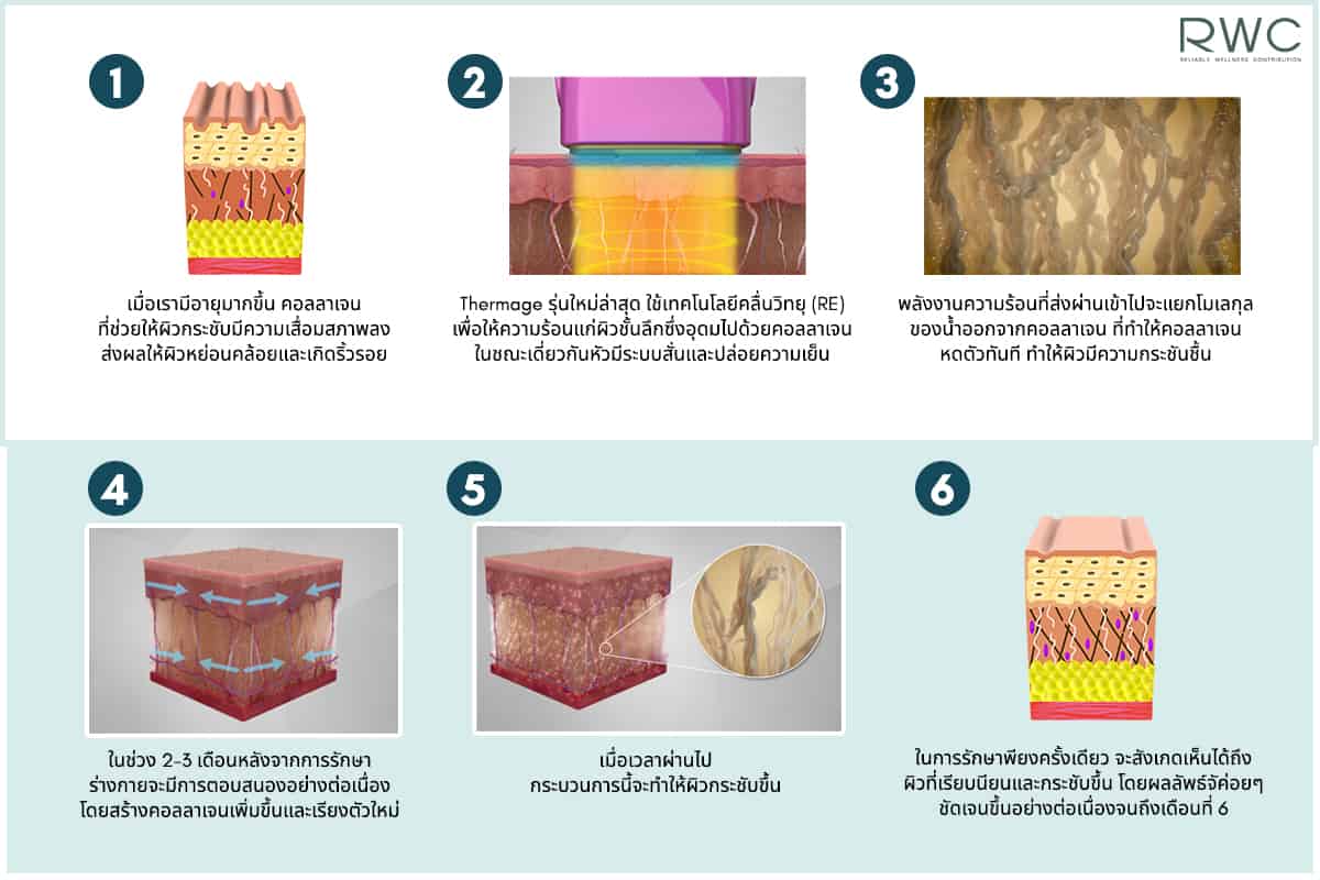 thermage คืออะไร