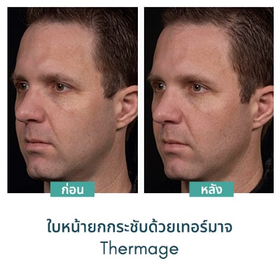 thermage