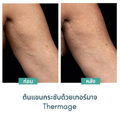 thermage รีวิว