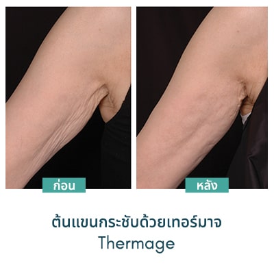 thermage คือ