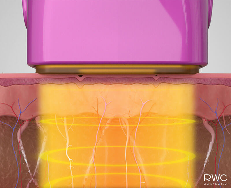 หลักการทำงานของ Thermage