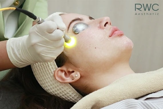 การรักษาสิวด้วย Dual yellow laser รักษาสิว อย่างไรให้ได้ผลดี