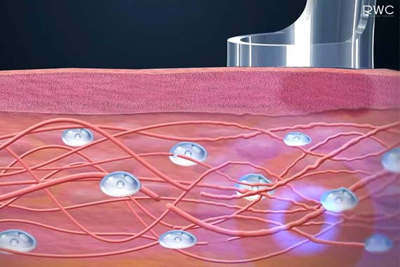รักษาสิวโดยใช้ Pico Laser รักษาสิว อย่างไรให้ได้ผลดี