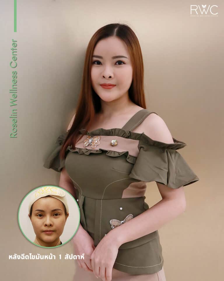 fat ฉีดไขมันหน้า เด็ก รีวิว