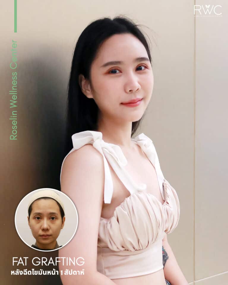 fat filler ฉีดไขมันหน้า เด็ก รีวิว