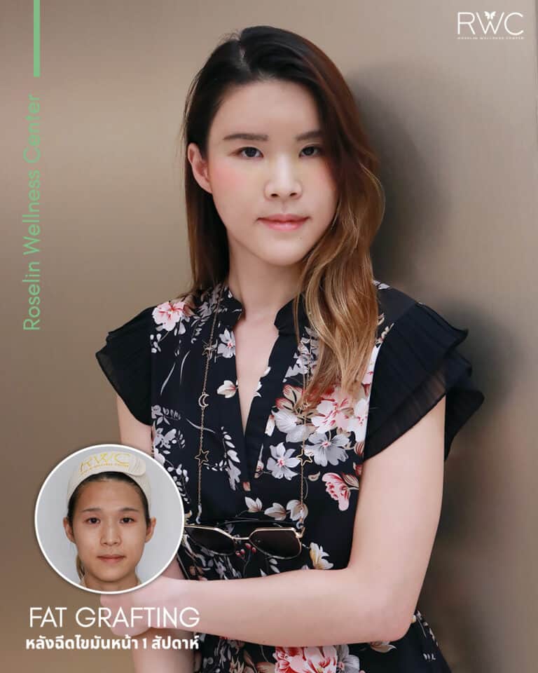 fat ฉีดไขมันหน้า รีวิว
