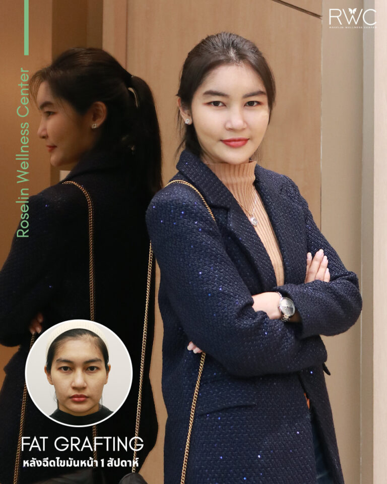 fat filler ฉีดไขมันหน้า รีวิว