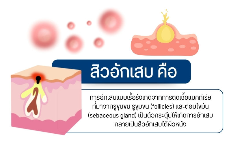 สิวอักเสบ คือ