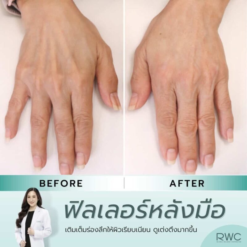 รีวิวฉีดฟิลเลอร์