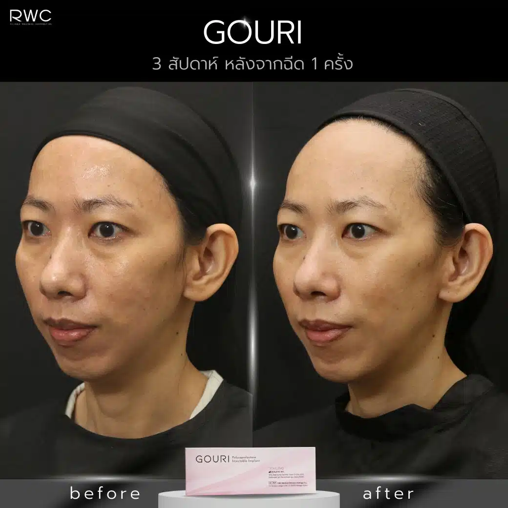 Gouri ฉีดฟื้นฟูผิว