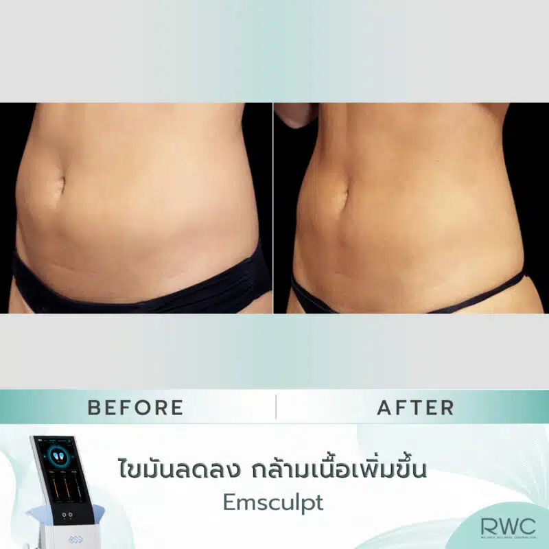 Emsculpt ผลลัพธ์