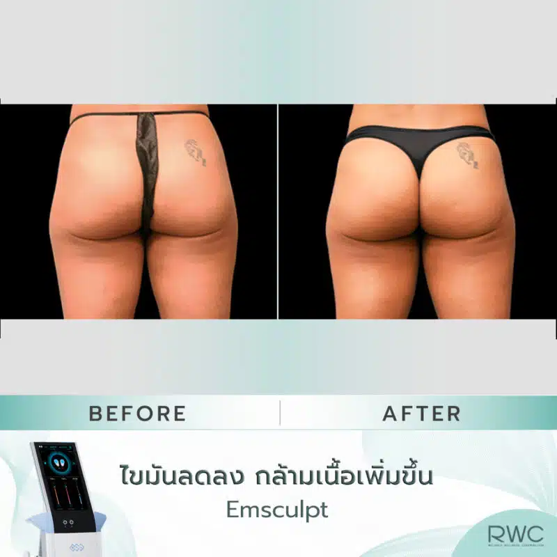 สะโพก Emsculpt ผลลัพธ์