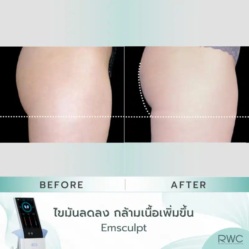 Emsculpt สะโพก