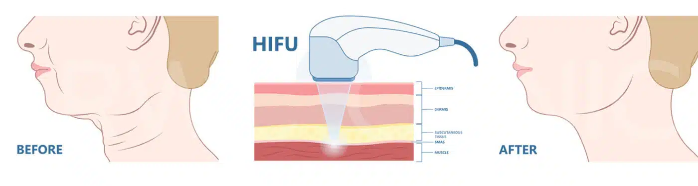 hifu ก่อนทำ หลังทำ