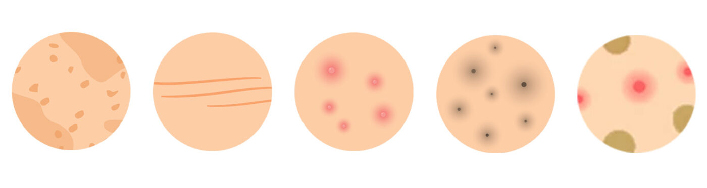 dual yellow laser types of skin