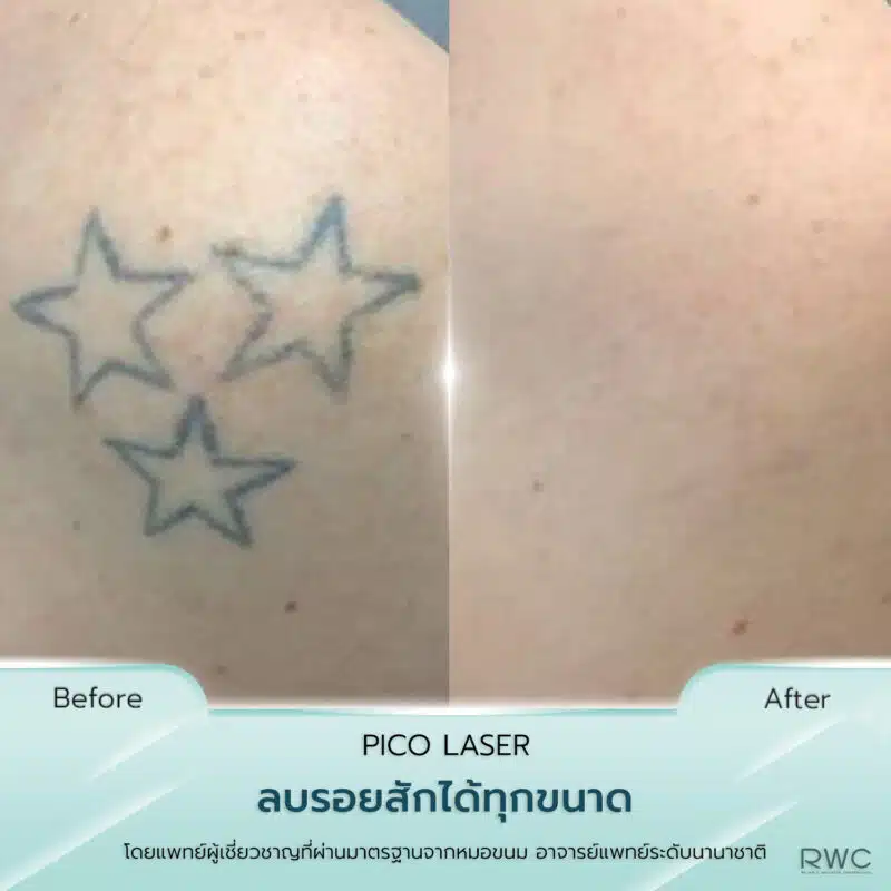 pico laser รีวิว รอยสัก