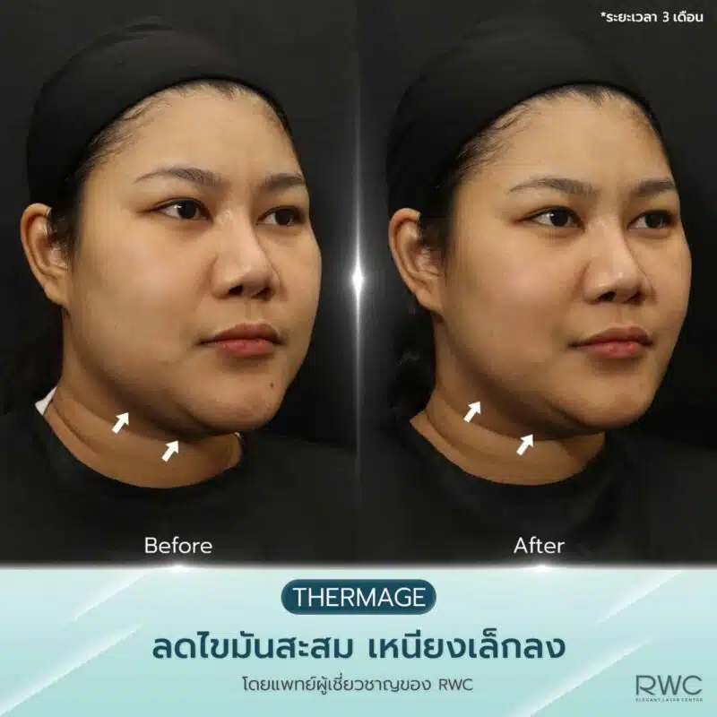 thermage รีวิว ก่อน-หลัง