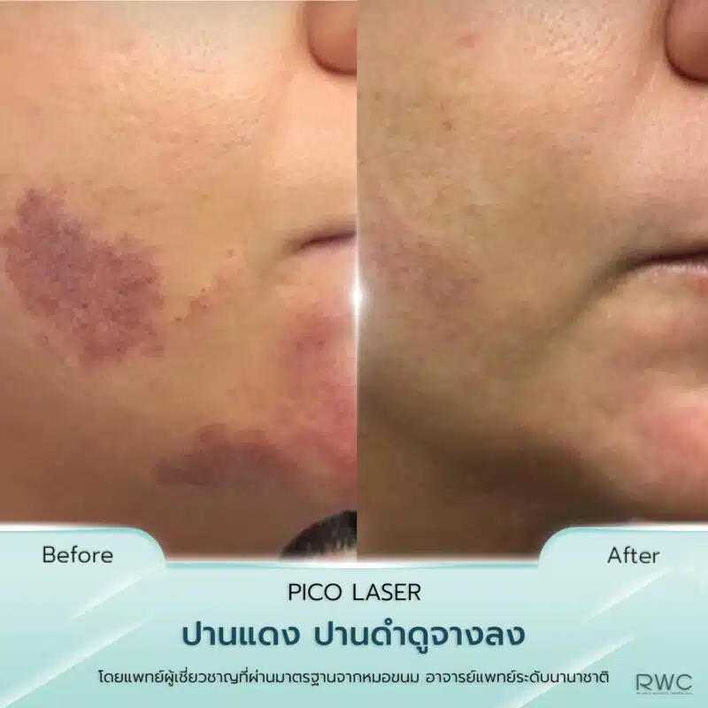 pico laser ปานแดง