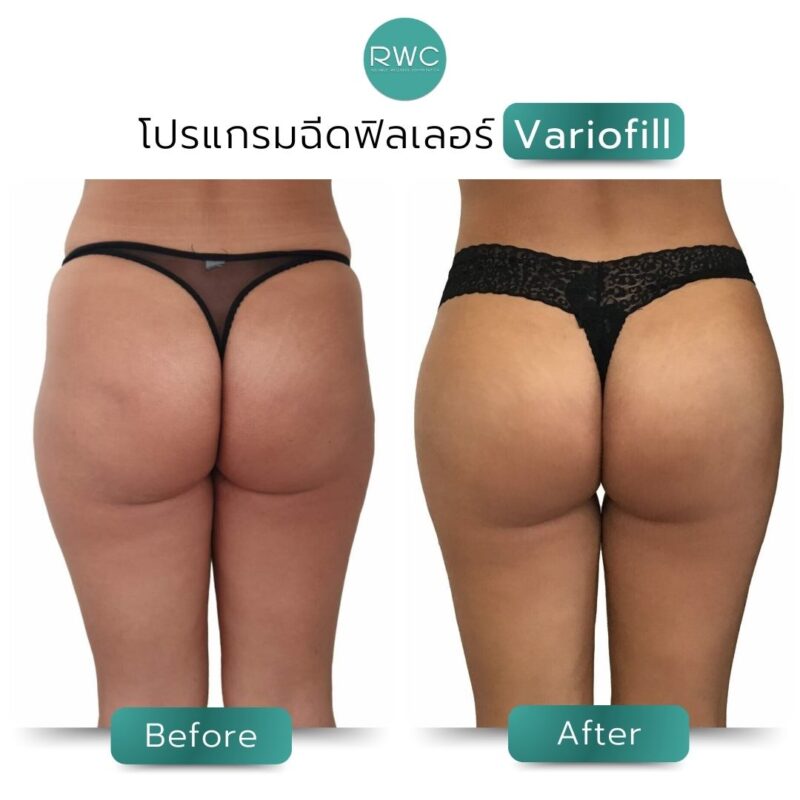 รีวิว ฟิลเลอร์ variofill