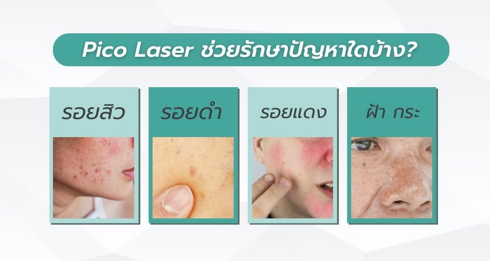 Pico Laser ช่วยอะไรบ้าง