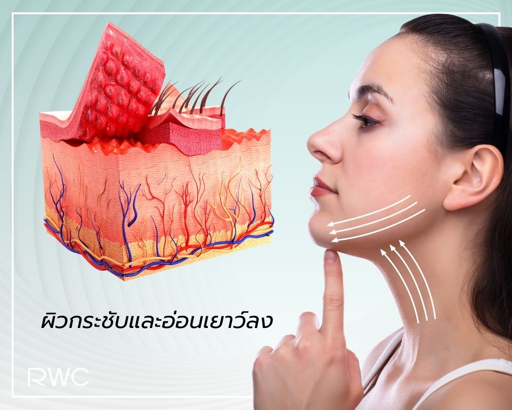 Thermage (เทอร์มาจ)