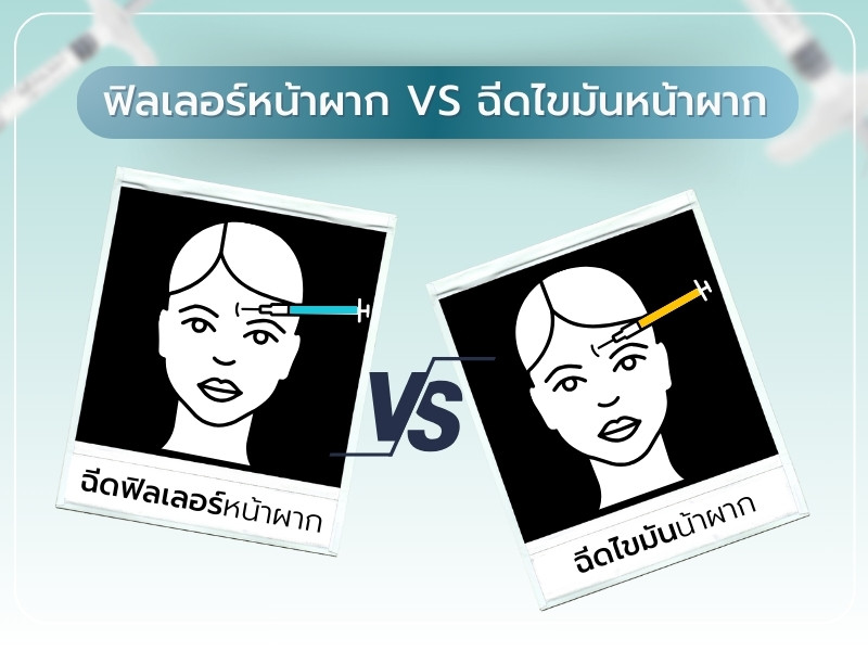 ฟิลเลอร์หน้าผาก vs การฉีดไขมัน