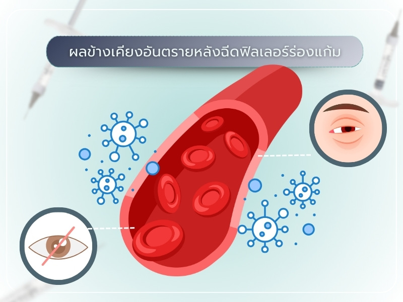 ผลข้างเคียงทั่วไปหลังฉีดฟิลเลอร์ร่องแก้ม