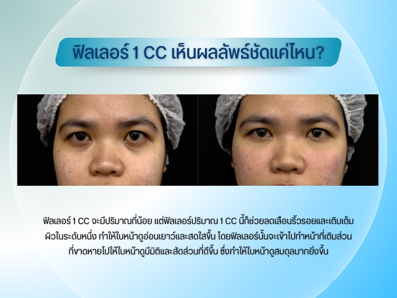 ฟิลเลอร์ 1 CC เห็นผลลัพธ์ชัดแค่ไหน