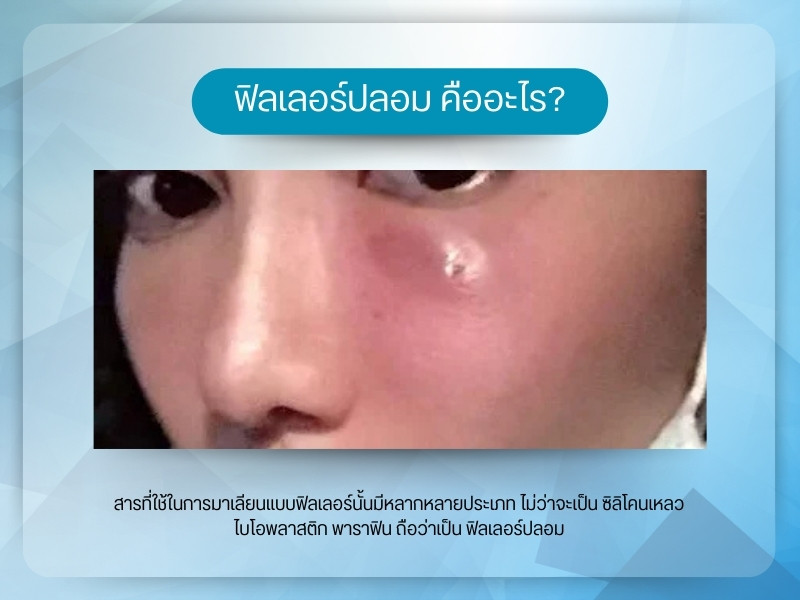 ฟิลเลอร์ปลอม คืออะไร