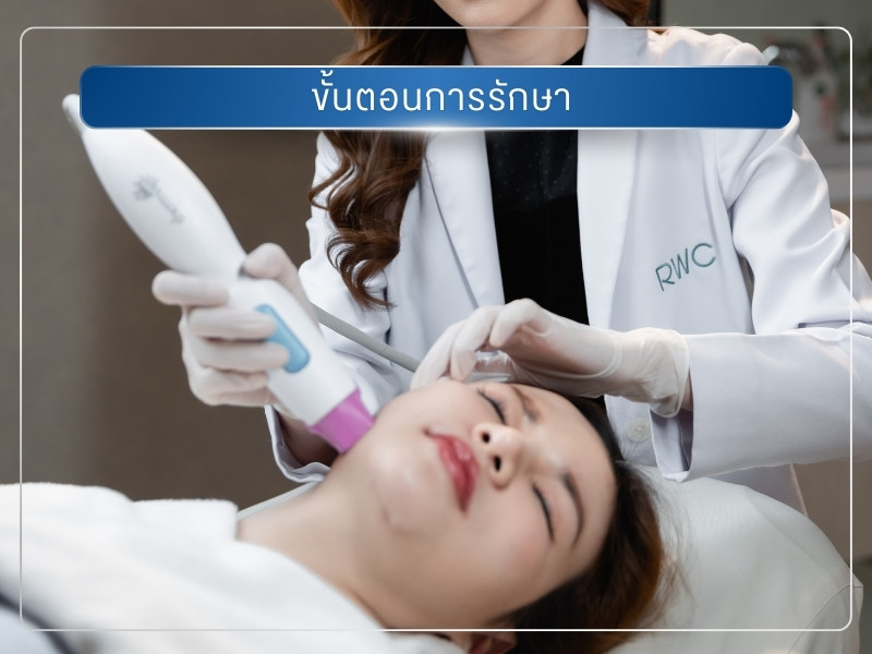 ทำ Thermage ขั้นตอนการรักษา