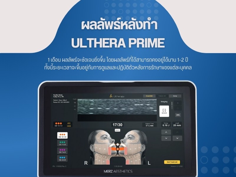 ผลลัพธ์หลังทำ Ulthera Prime