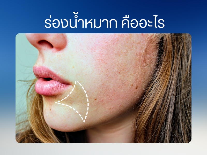 ร่องน้ำหมาก คืออะไร