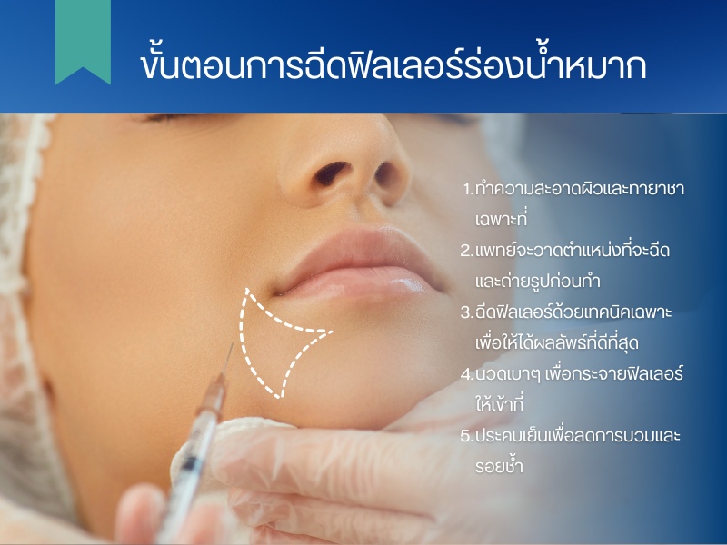 ข้อดีของการฉีดฟิลเลอร์ร่องน้ำหมาก