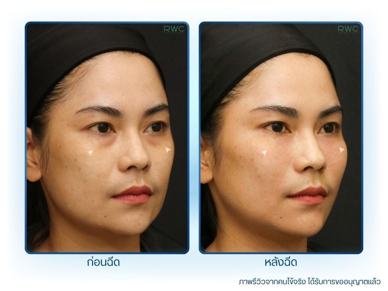 ก่อน-หลัง รีวิวการฉีดฟิลเลอร์ใต้ตา