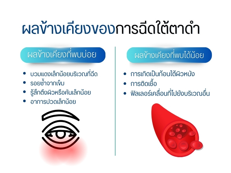 ผลข้างเคียงของการฉีดใต้ตาดำ