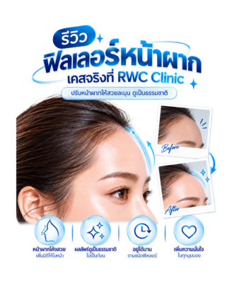 รีวิวฟิลเลอร์หน้าผาก