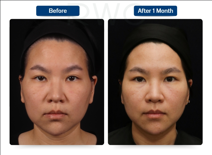 รีวิวฉีด HarmonyCa เจ็บไหม ที่ RWC Clinic