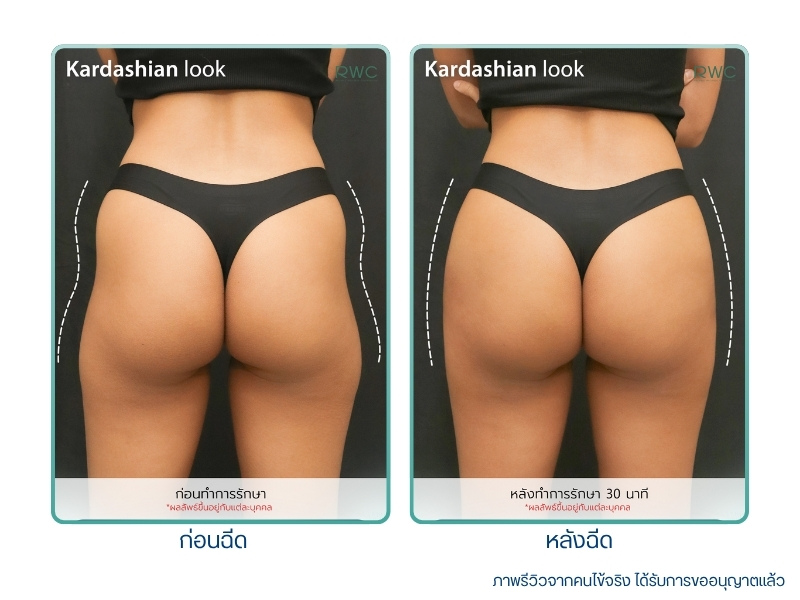 รีวิวฟิลเลอร์สะโพก