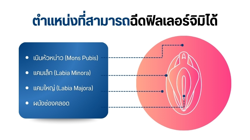 ตำแหน่งที่สามารถฉีดฟิลเลอร์จิมิได้