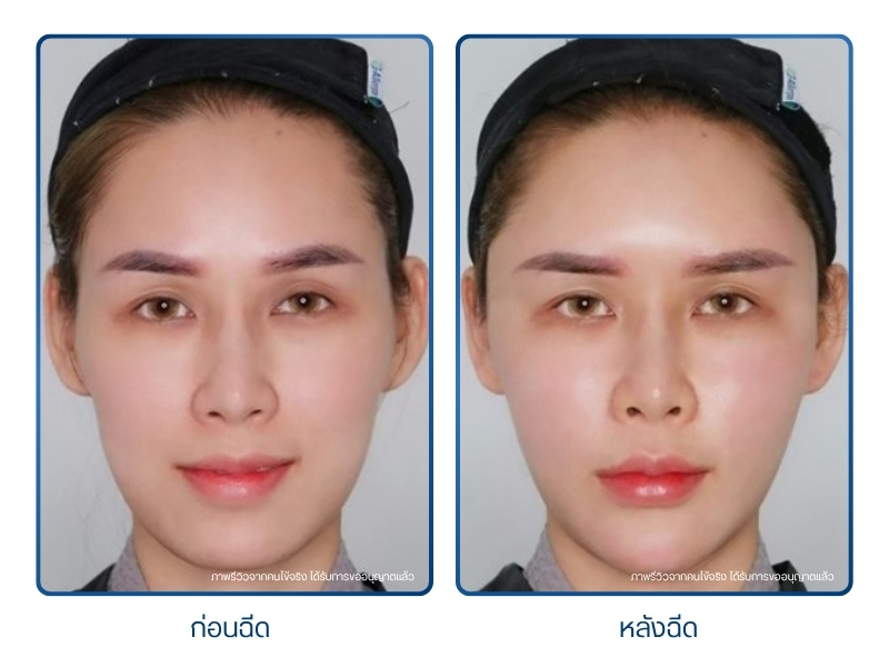 รีวิวไขมันหน้า