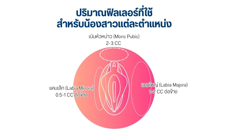 ปริมาณฟิลเลอร์ที่ใช้สำหรับน้องสาวแต่ละตำแหน่ง