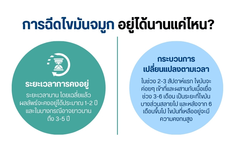 การฉีดไขมันจมูก อยู่ได้นานแค่ไหน?