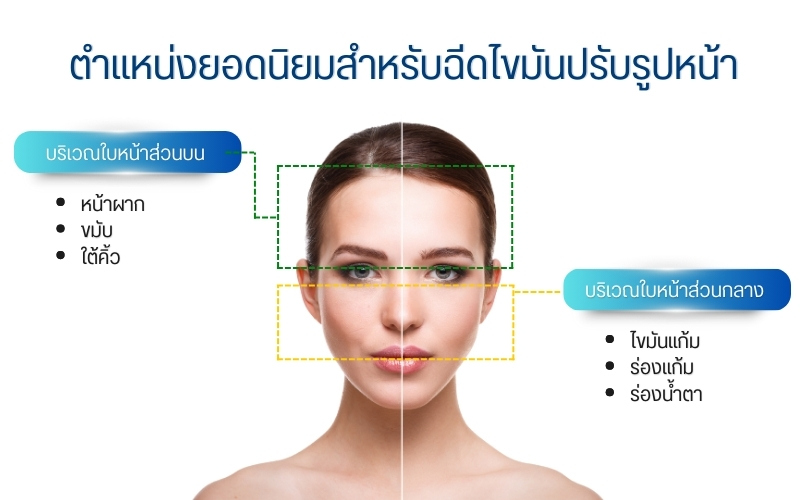 ตำแหน่งยอดนิยมสำหรับฉีดไขมันปรับรูปหน้า