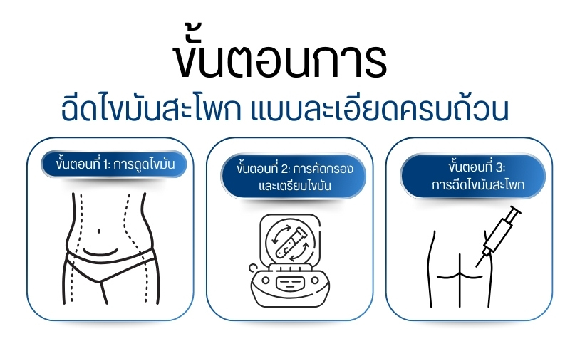 ขั้นตอนการฉีดไขมันสะโพก แบบละเอียดครบถ้วน