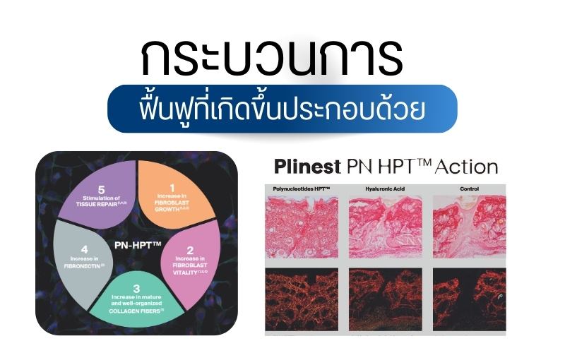 กลไกการทำงานและส่วนประกอบของ Plinest
