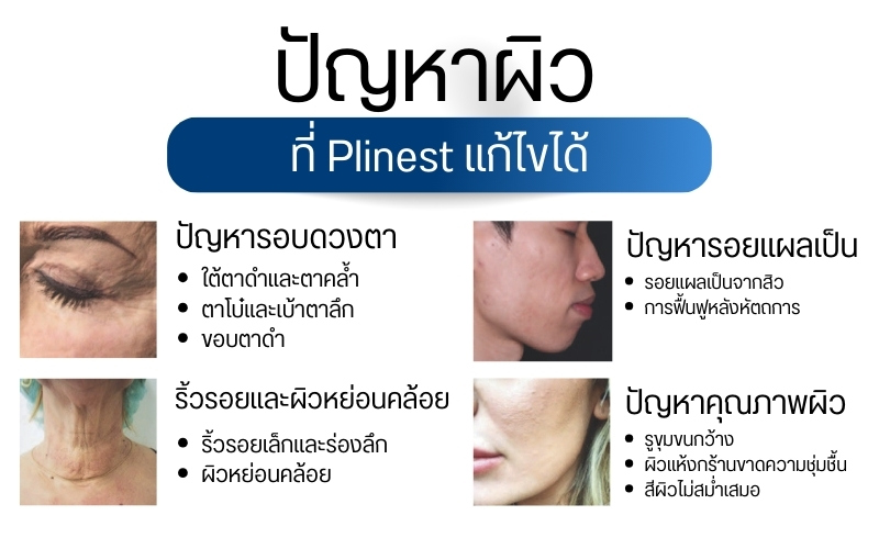 ปัญหาผิวที่ Plinest แก้ไขได้