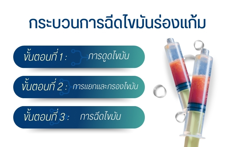กระบวนการฉีดไขมันร่องแก้ม